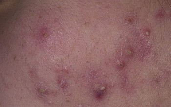 Гнойные прыщи