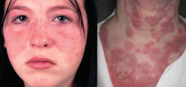 Сыпь болит голова слабость