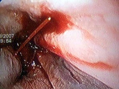 Болит спина сзади где ребра