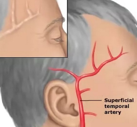 Болит голова со стороны правого виска