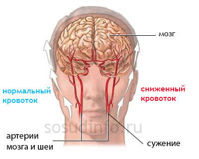 Если болит голова сужение сосудов