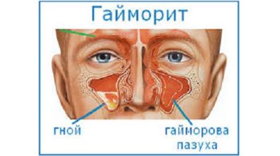 Болит спина в области позвоночника температура