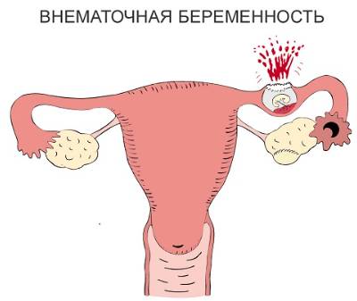 Болит низ спины у женщины в середине цикла