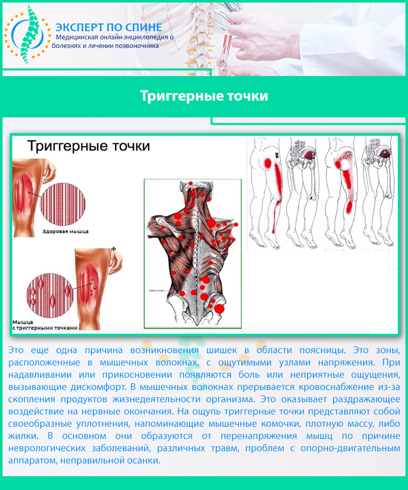 Триггерные точки