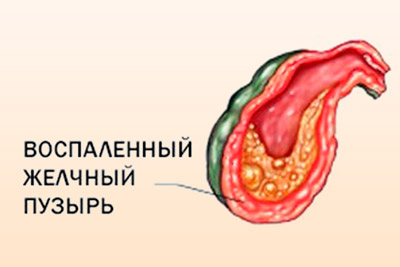 Холецистит Воспаление желчного пузыря