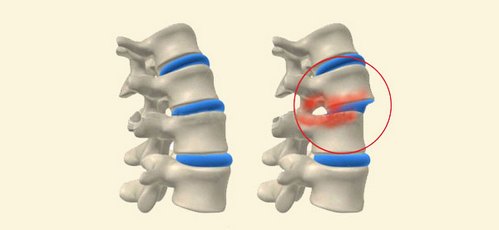 Болит спина когда качаюсь