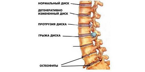 Болит спина когда качаюсь