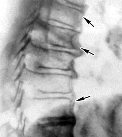 Болит сам позвоночник посередине спины