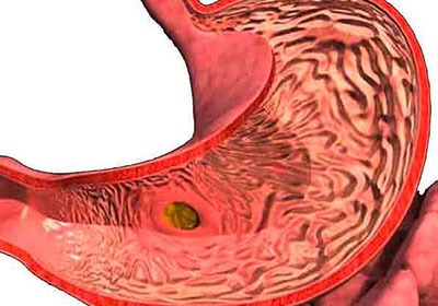 Рвет болит голова и болит желудок что это