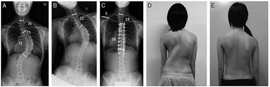 Исправление сколиоза