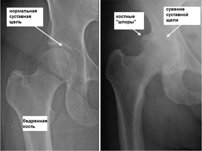 Лежа на спине болит таз