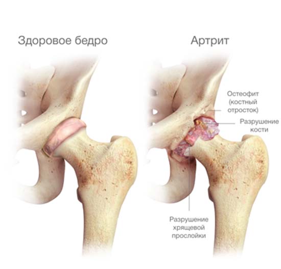 Здоровый и пораженный артритом тазобедренный сустав Артрит тазобедренного сустава