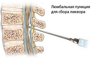 как долго может болеть спина после пункции