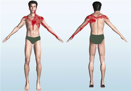 Распространение боли при инфаркте Распространение боли при инфаркте