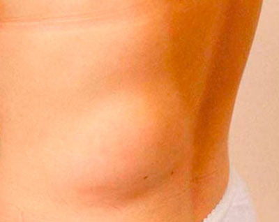 Шишка на спине в области поясницы Шишка на спине под кожей в области поясницы