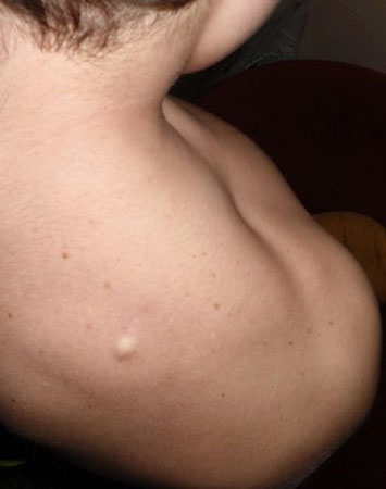 Подкожная шишка на спине болит что это