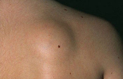 Подкожная шишка на спине болит что это