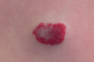 Гемангиома Подкожная шишка на спине болит что это