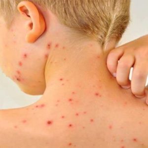 Сыпь болит голова слабость