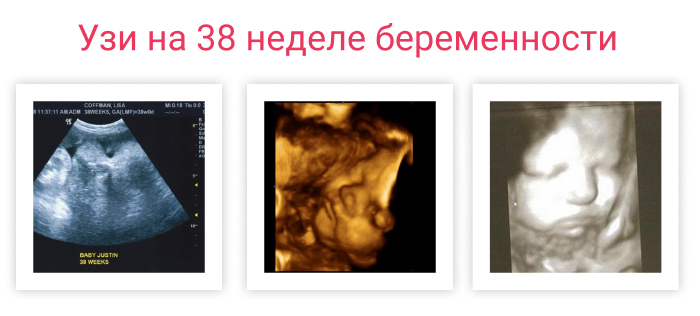 узи на 38 неделе беременности