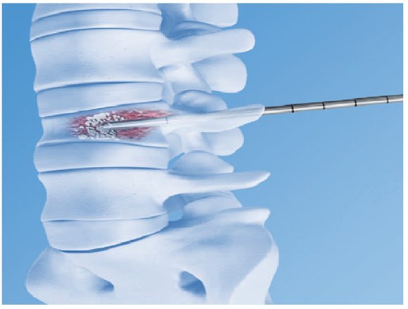 Вертебропластика